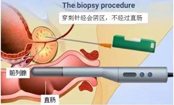 前列腺最新技術(shù)，重塑治療與管理未來(lái)的新篇章